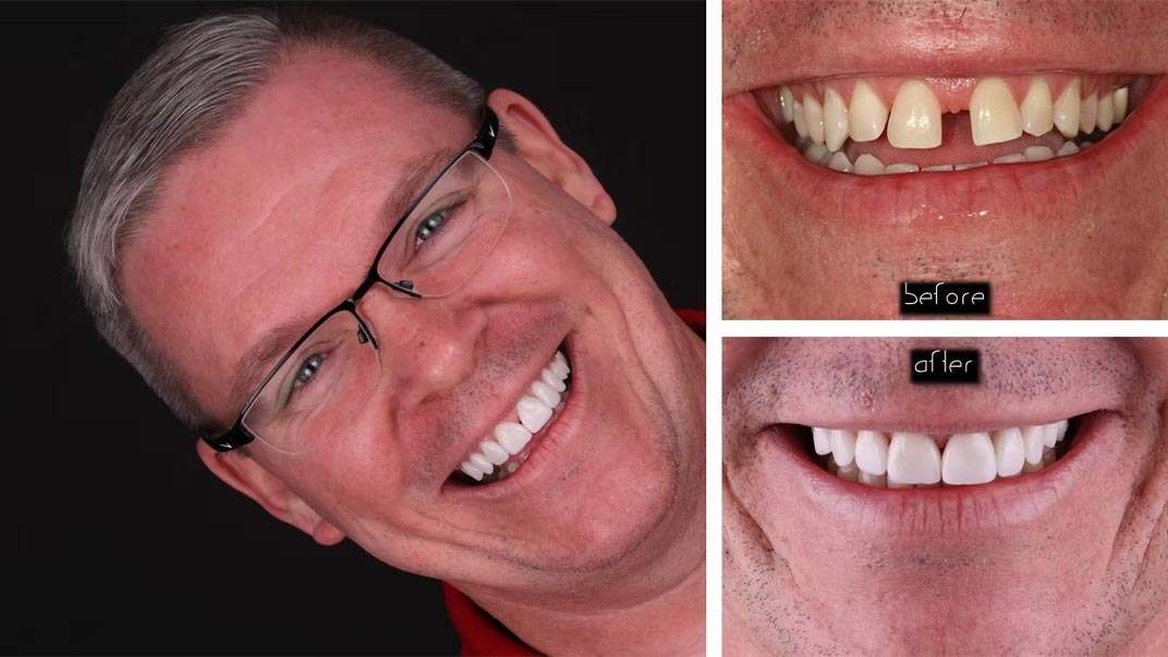 The image shows a man with a wide smile, displaying a full set of dental implants, with three different views of his teeth and gums against a black background.