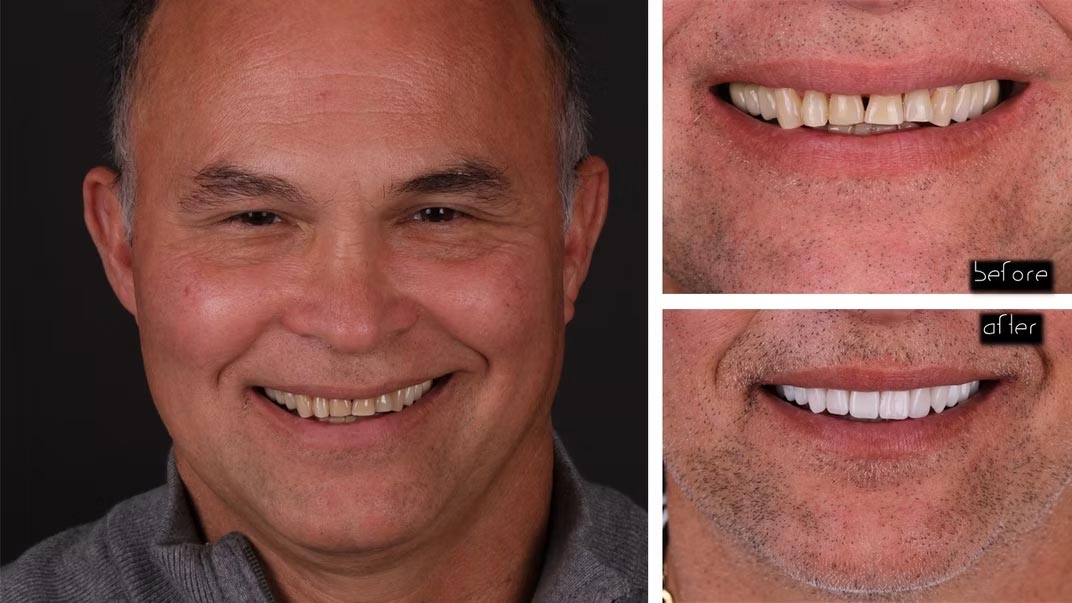 The image shows a man with a large smile, displaying his teeth before and after dental treatment.