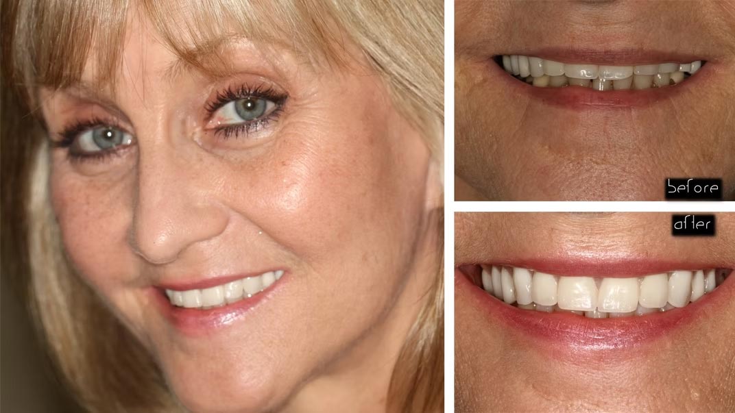 The image shows a woman with a wide smile before and after a cosmetic dental procedure, highlighting the transformation achieved through teeth whitening.