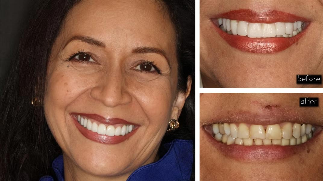 The image displays a woman with a broad smile showing her teeth, which are being straightened with braces, against a background that includes two smaller images of her smiling face at different ages.