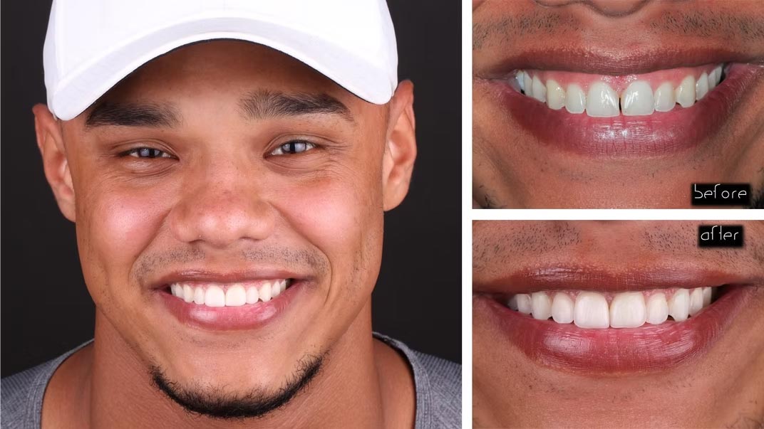 This image displays a person smiling at the camera with their mouth open, showcasing their teeth, against a black background. The individual appears to be wearing a white cap with a logo on the front and a gray shirt.