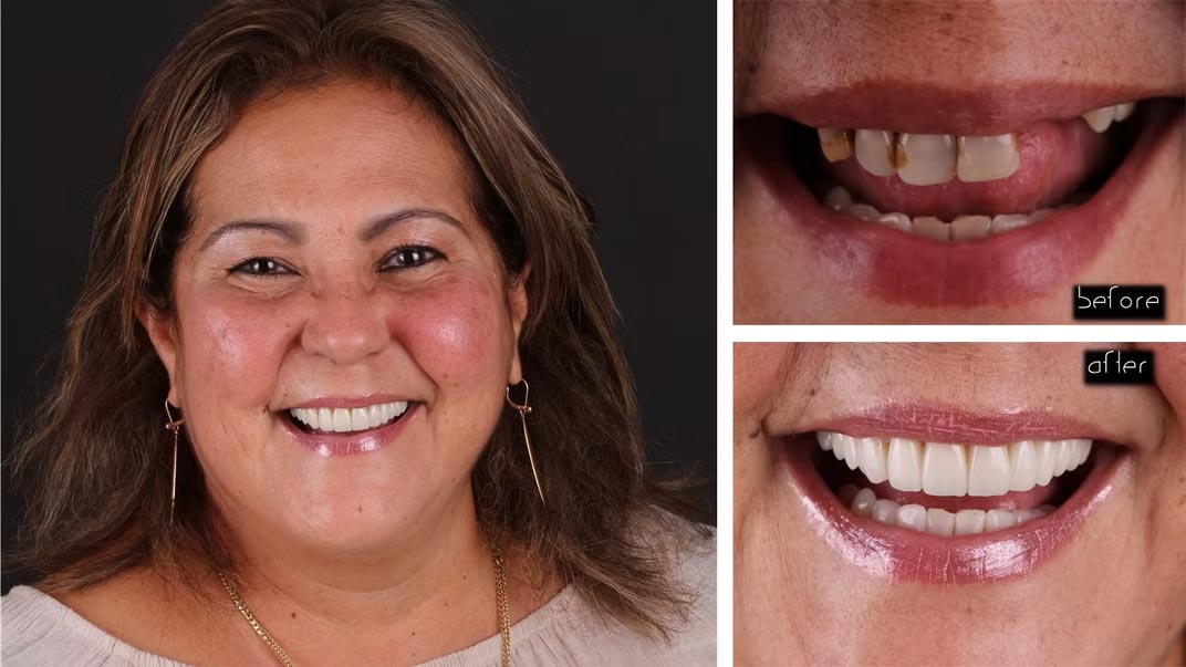 The image displays a woman with a wide smile showcasing her teeth, presented in a collage format with different angles and expressions.