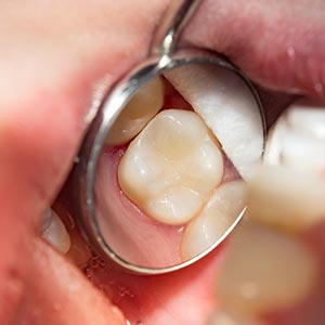 The image shows a close-up view of an open mouth with a tooth being extracted, featuring a dental mirror and a metal instrument, all set against a red, swollen gum area.