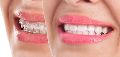 The image shows two close-ups of a person s face with a wide smile, revealing teeth and lips.