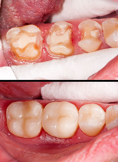 This image shows a close-up view of a person s mouth with several teeth that are yellowed and decaying, indicating poor oral hygiene and potential dental issues.
