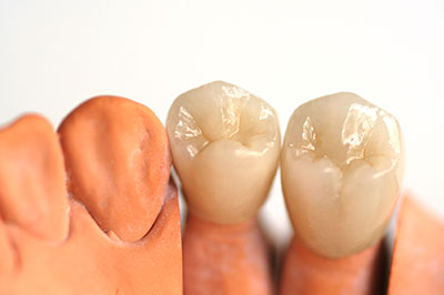 The image shows a set of artificial teeth displayed against a white background, with some appearing to be missing pieces.