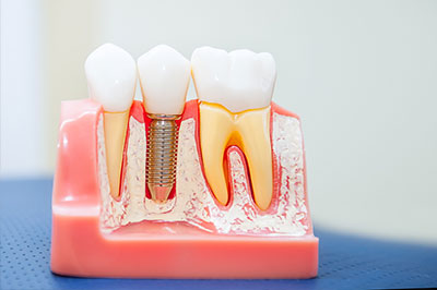 The image shows a dental model with artificial teeth, some of which have visible fillings and implants, displayed on a red base against a blue background.