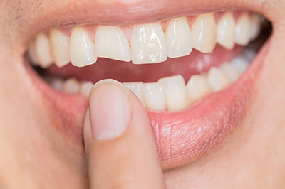 The image shows a close-up of a person s mouth with teeth, holding a finger over their lower lip, which is partially open revealing a smile with a visible gap between the front teeth.