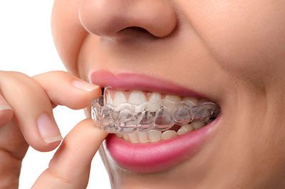 The image shows a person with braces holding their teeth together while smiling.