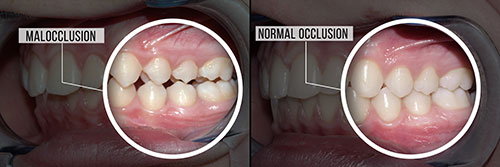 The image shows a sequence of four photographs featuring an individual s teeth undergoing a dental procedure with captions explaining each step, including  Malocclusion,   No RMMA,   DC,  and  DCL.