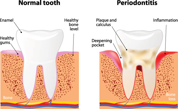 The image presents a detailed illustration of a tooth with normal and gum disease states, labeled as  normal  and  periodontitis,  accompanied by a diagram showing the progression from healthy teeth to advanced gum disease with bone loss.