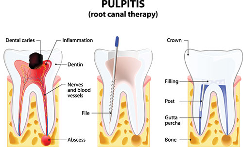 The image displays a diagrammatic illustration of a human dental anatomy with labels indicating various parts of the mouth, including teeth, gums, tongue, and roots, highlighting the structure of a tooth root in relation to pulpitis.
