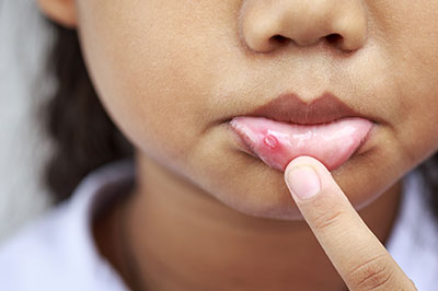 The image shows a close-up of a young child s face with a noticeable pimple on the nose, using their index finger to touch the blemish.
