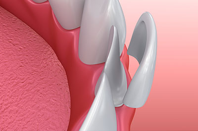 The image displays a close-up view of a dental implant with an artificial gum line, showing the top surface of the implant with a pinkish-red material that mimics the appearance of real gums.