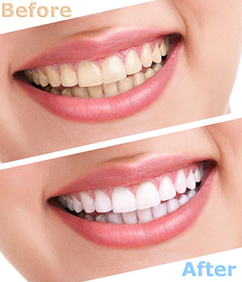 The image shows a woman s smile before and after teeth whitening treatment, highlighting the transformation achieved through dental care services.